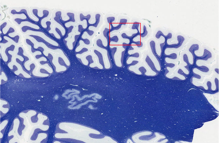 Central neuropathology of Minamata disease